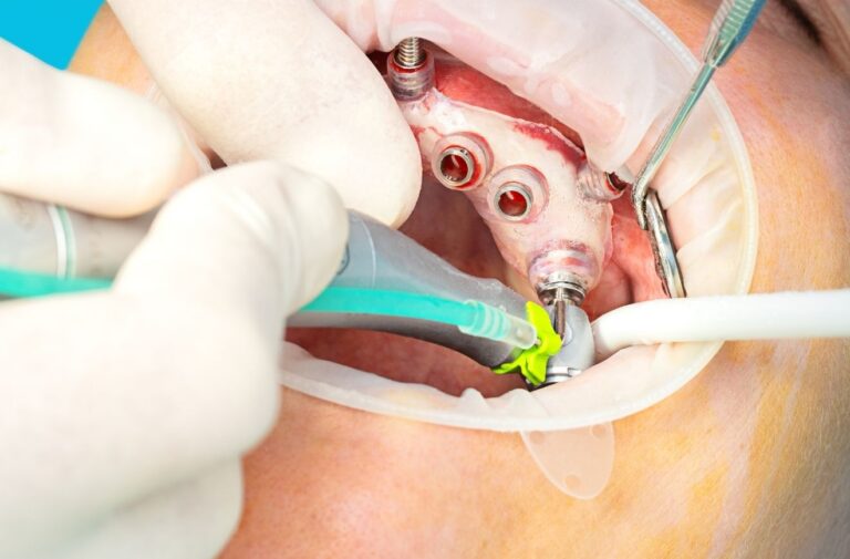 Guided-Implant-Surgery-1