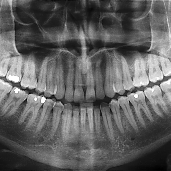 x-ray